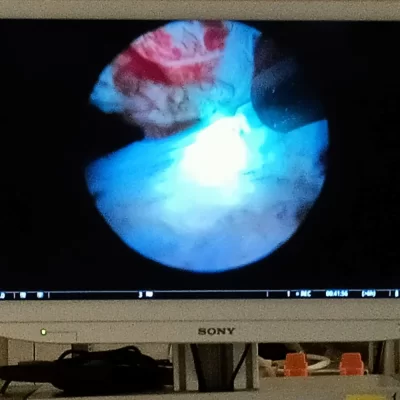 HoLEP Prostat Ameliyatı Fotoğraflar